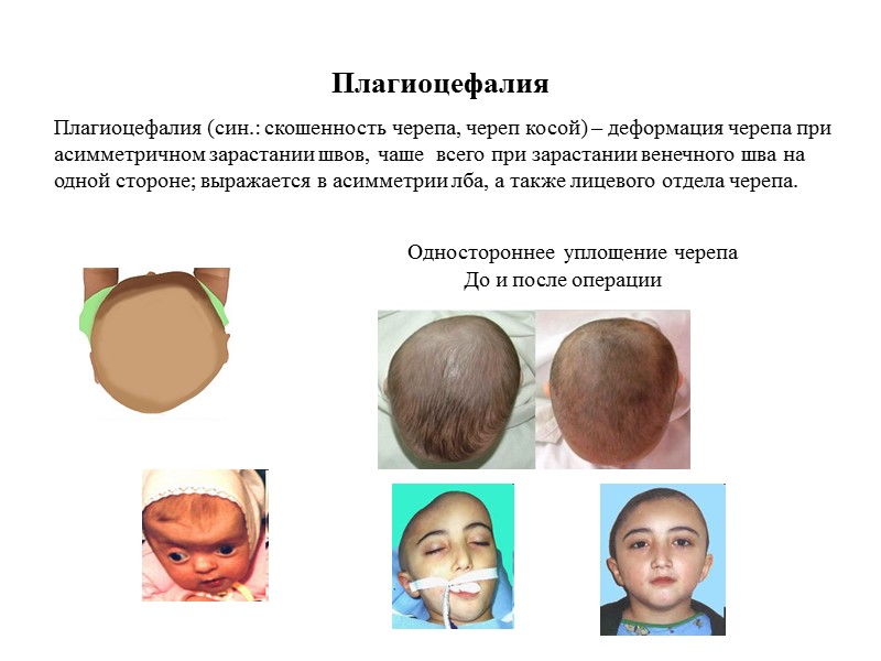 Плагиоцефалия Одностороннее  уплощение черепа До и после операции Плагиоцефалия (син.: скошенность черепа, череп